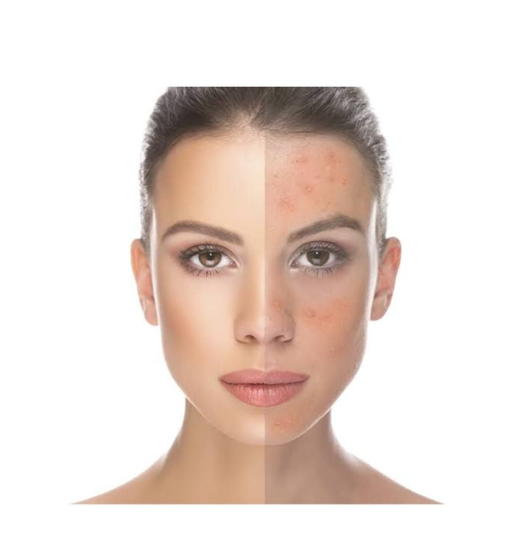 Acne - Manual da acne - Estética Hillary